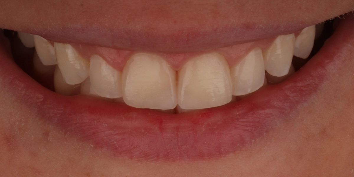 Veneers1_nachher