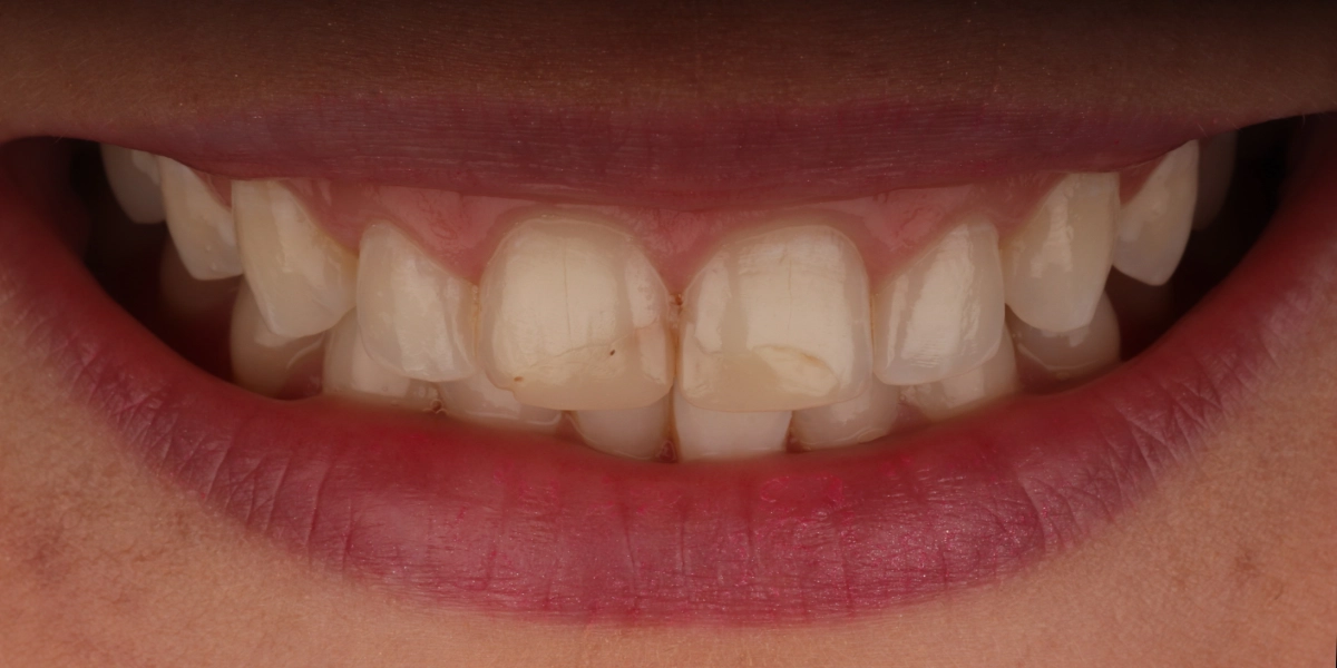 Veneers1_vorher