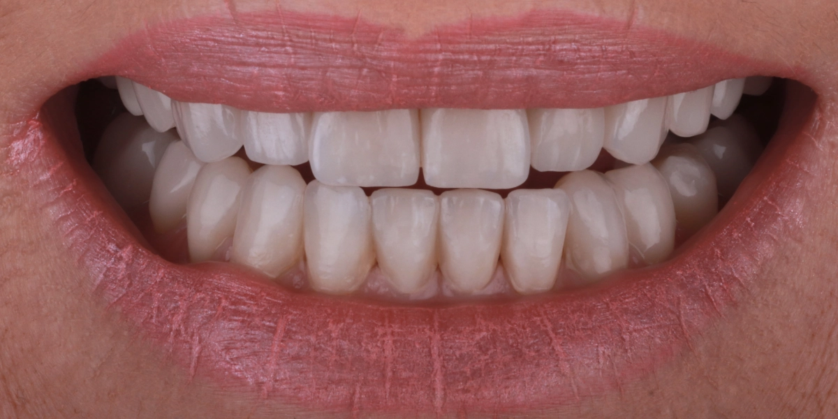 Veneers2_nachher