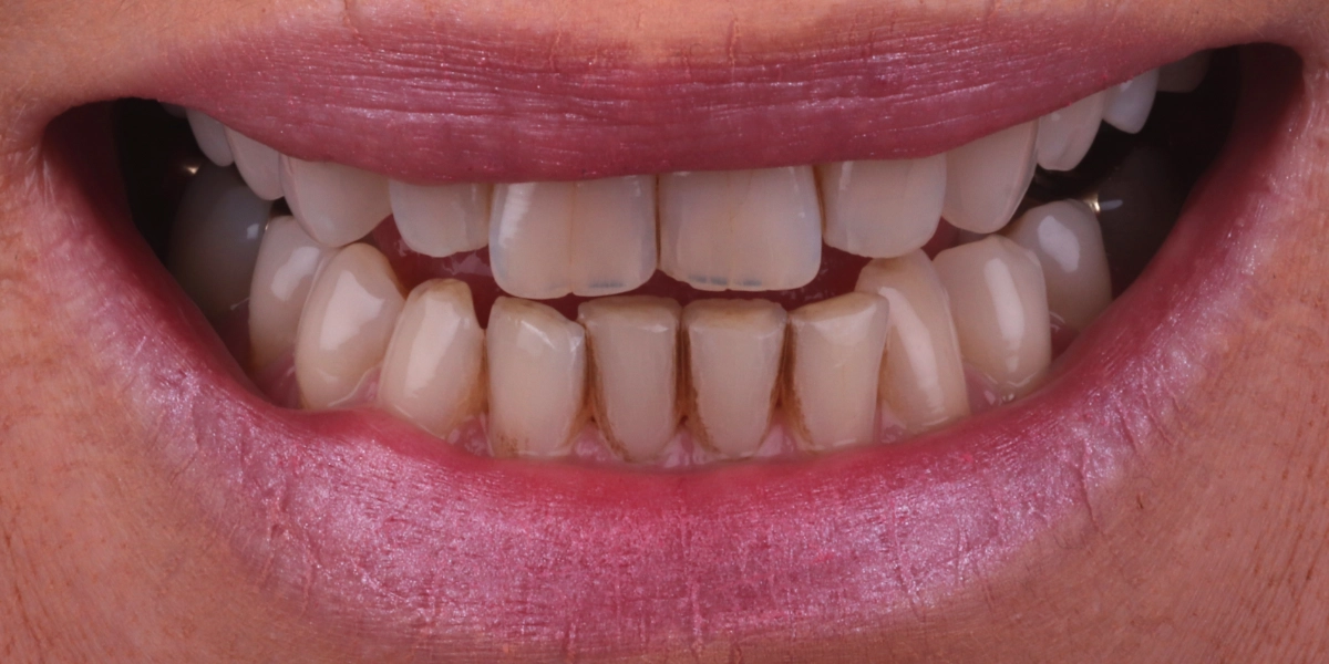 Veneers2_vorher