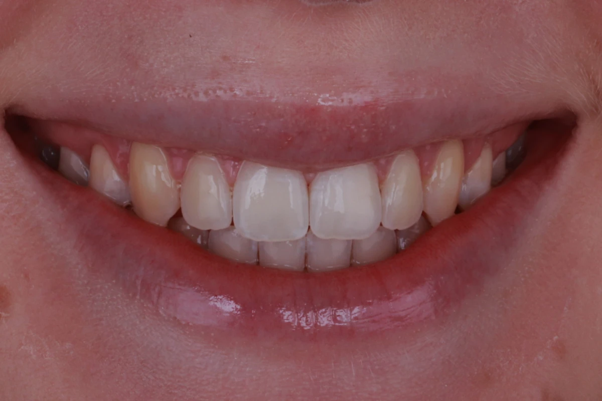 aligner-zahnarzt-krefeld-nachher-neu aligner-zahnarzt-krefeld-nachher-neu