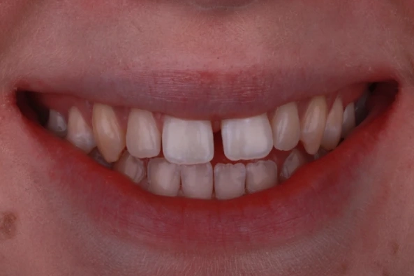 aligner-zahnarzt-krefeld-vorher-neu aligner-zahnarzt-krefeld-vorher-neu