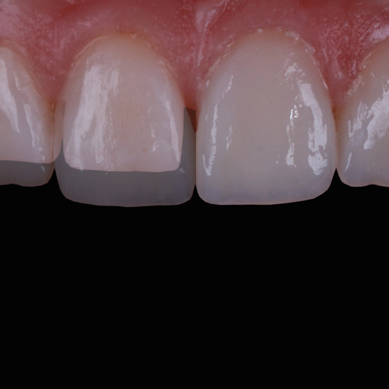 veneers zahnarzt krefeld 3