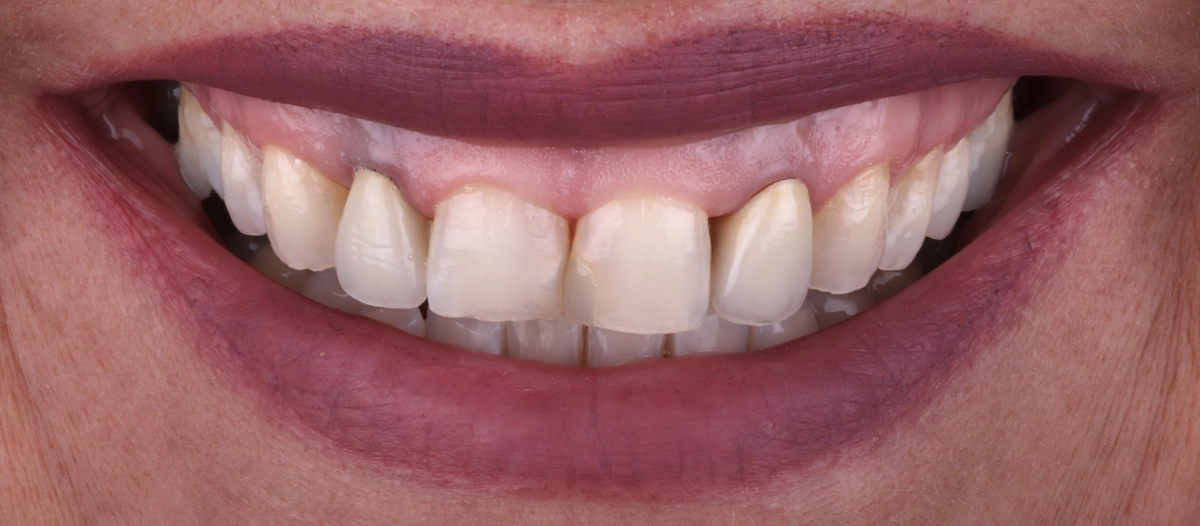 zahnarzt-krefeld-veneers-implantate-vorher zahnarzt-krefeld-veneers-implantate-vorher
