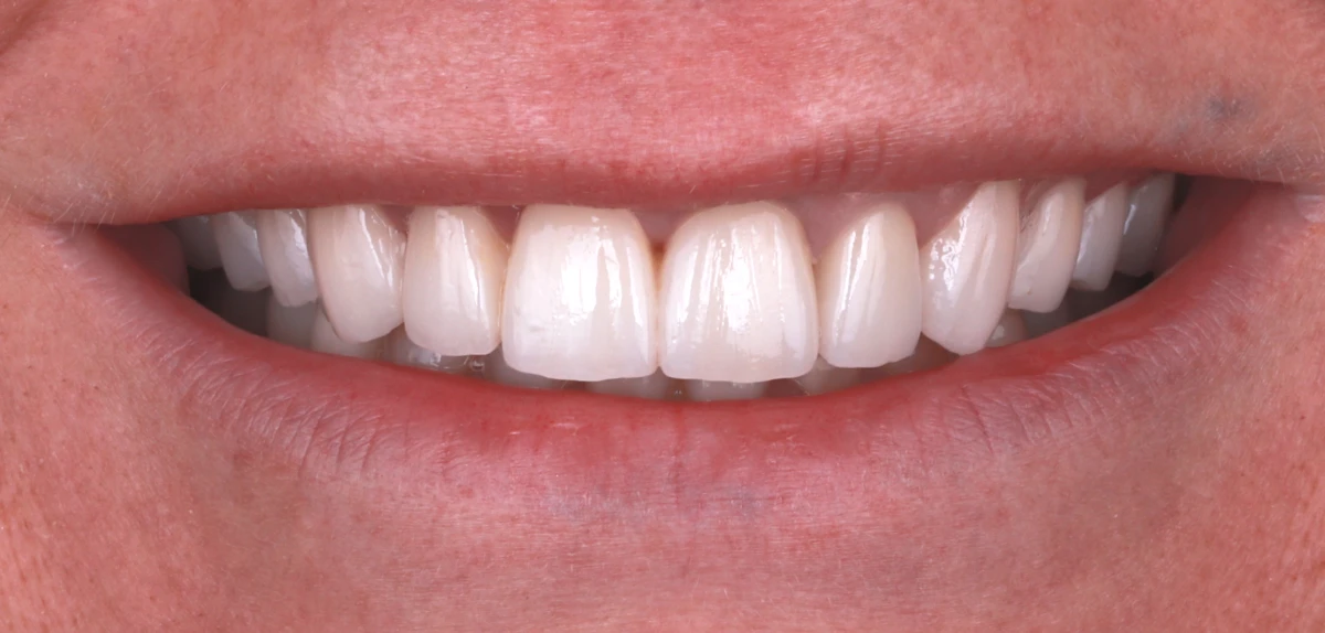 zahnarzt-krefeld-veneers-kronen-nachher zahnarzt-krefeld-veneers-kronen-nachher