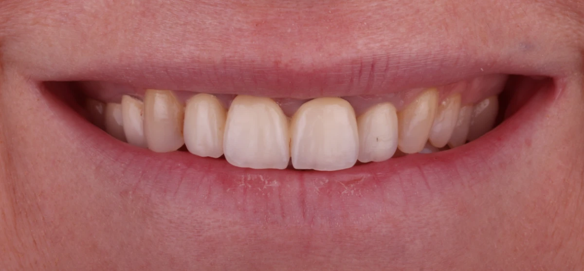 zahnarzt-krefeld-veneers-kronen-vorher zahnarzt-krefeld-veneers-kronen-vorher