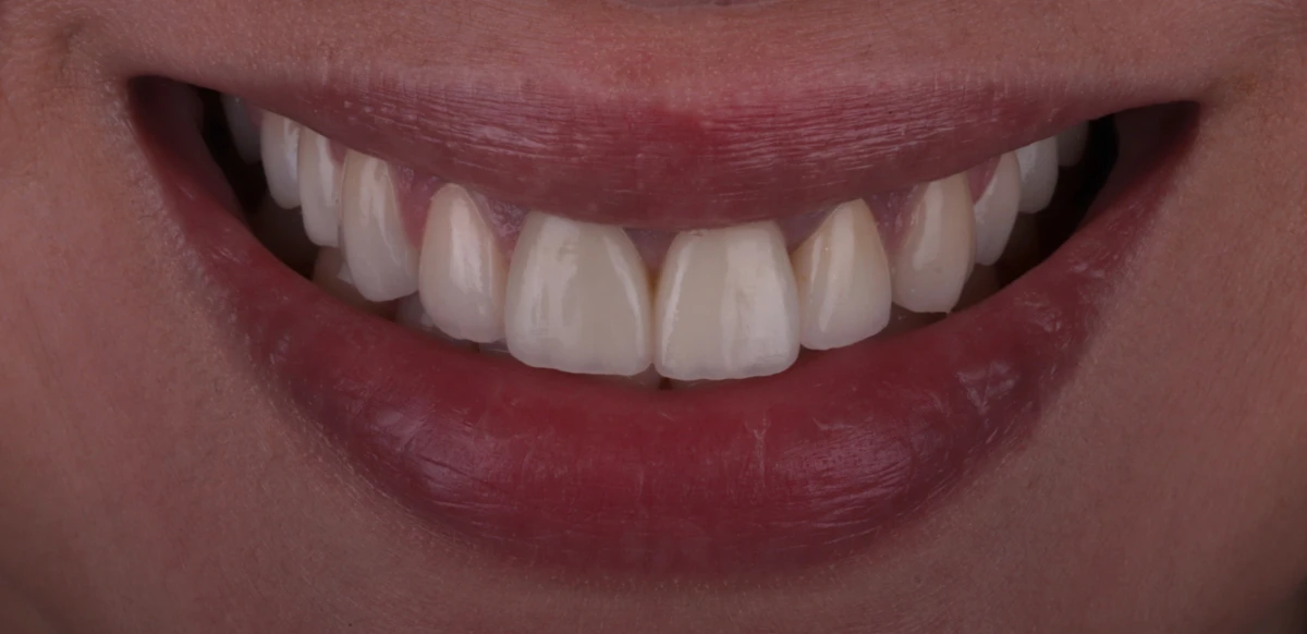 zahnarzt-krefeld-veneers-zahnersatz-nachher zahnarzt-krefeld-veneers-zahnersatz-nachher