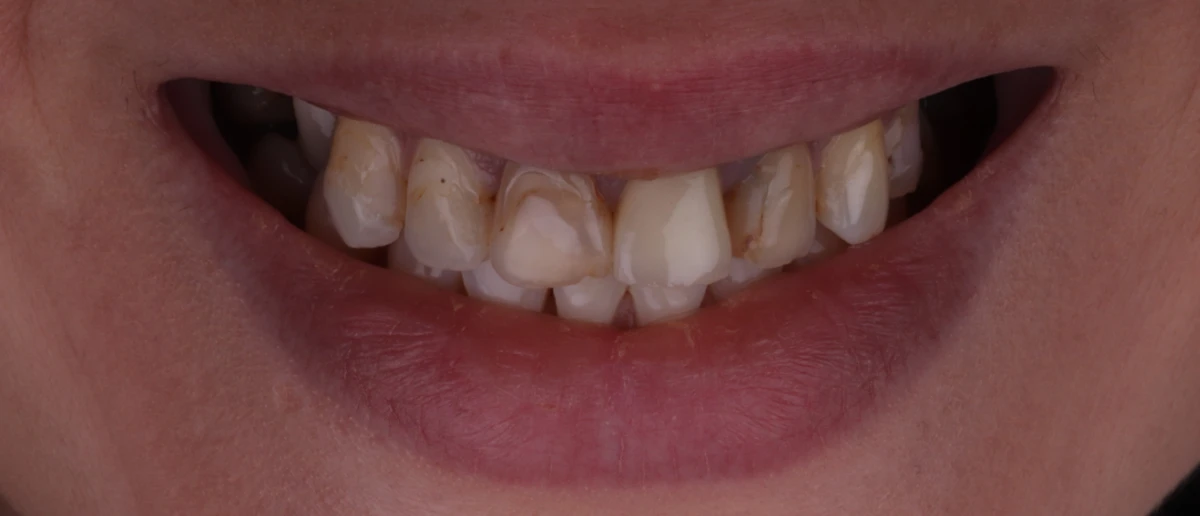 zahnarzt-krefeld-veneers-zahnersatz-vorher zahnarzt-krefeld-veneers-zahnersatz-vorher