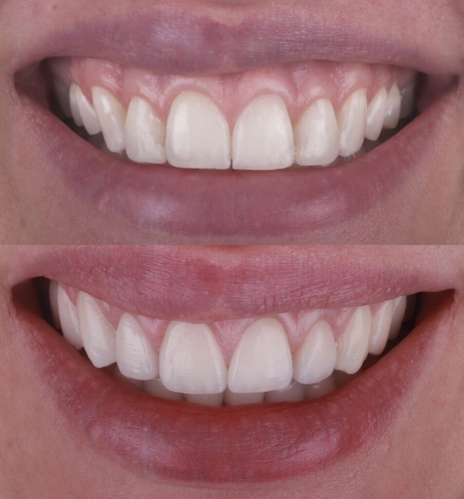 Gummy Smile Zahnflkorrektur chirur Knochenverl Veneers