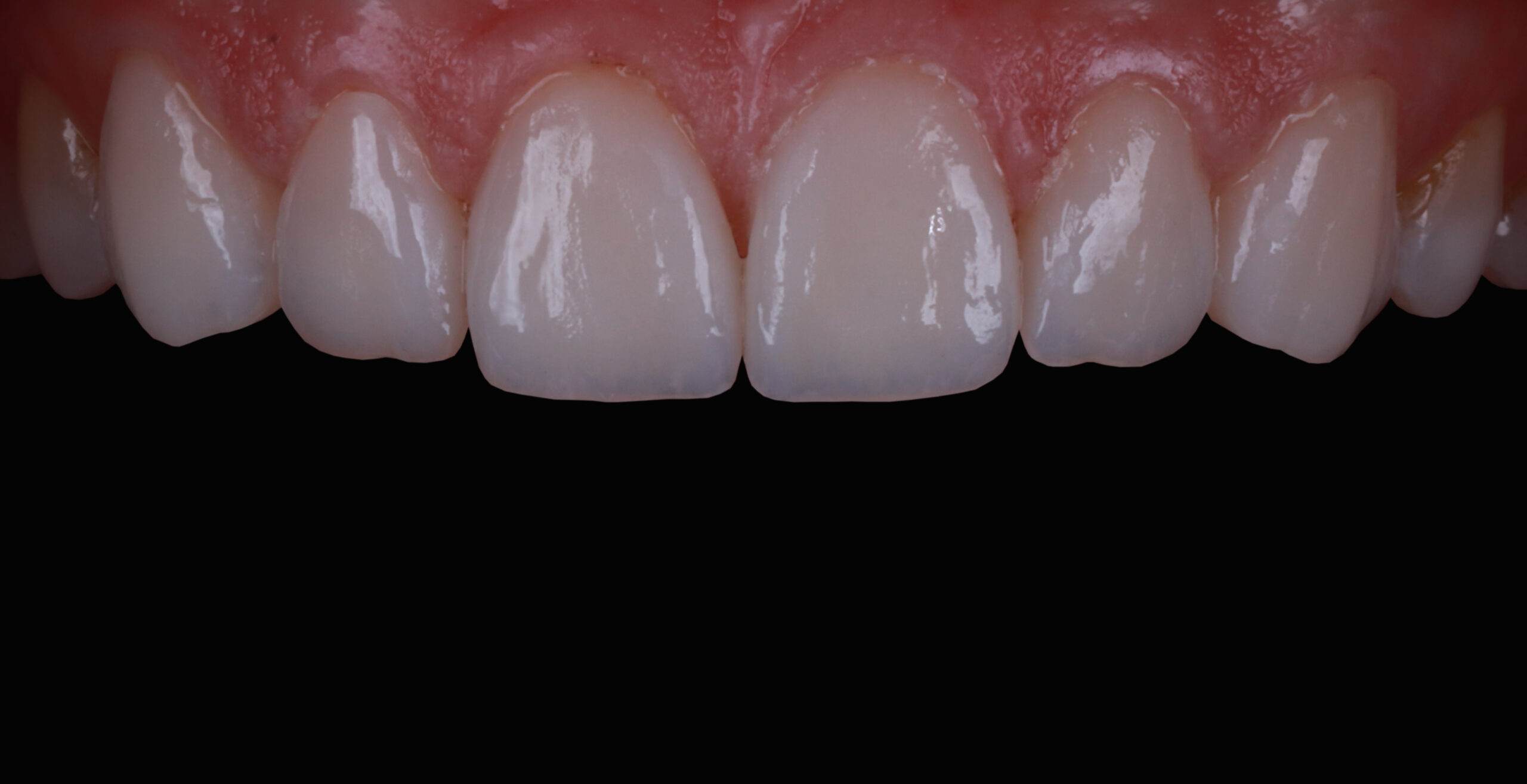 Veneers3_post