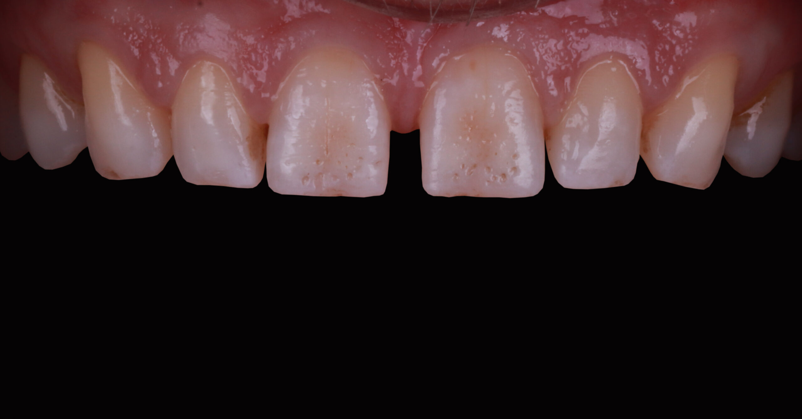 Veneers3_pre Veneers3_pre