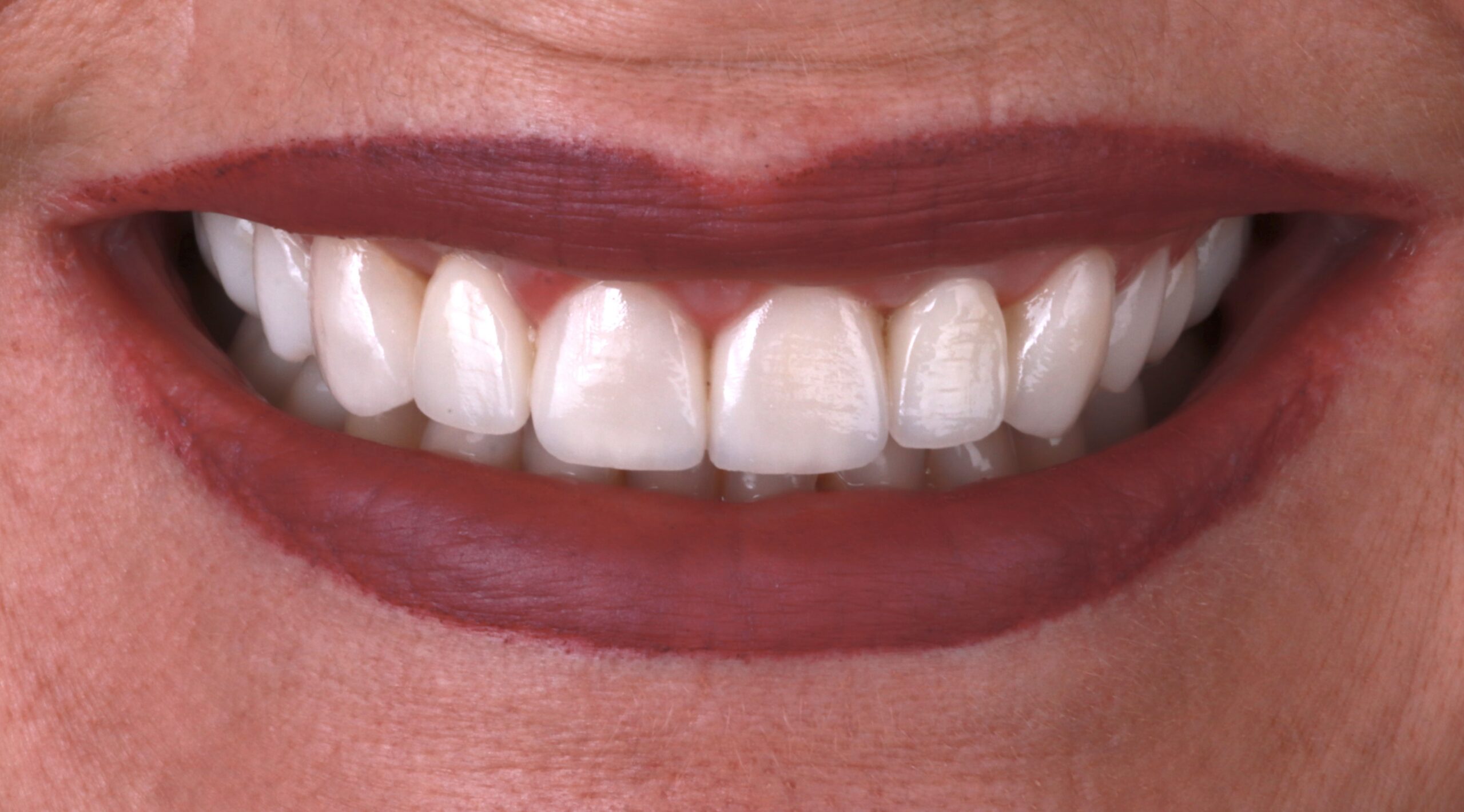 Veneers+Implants_post