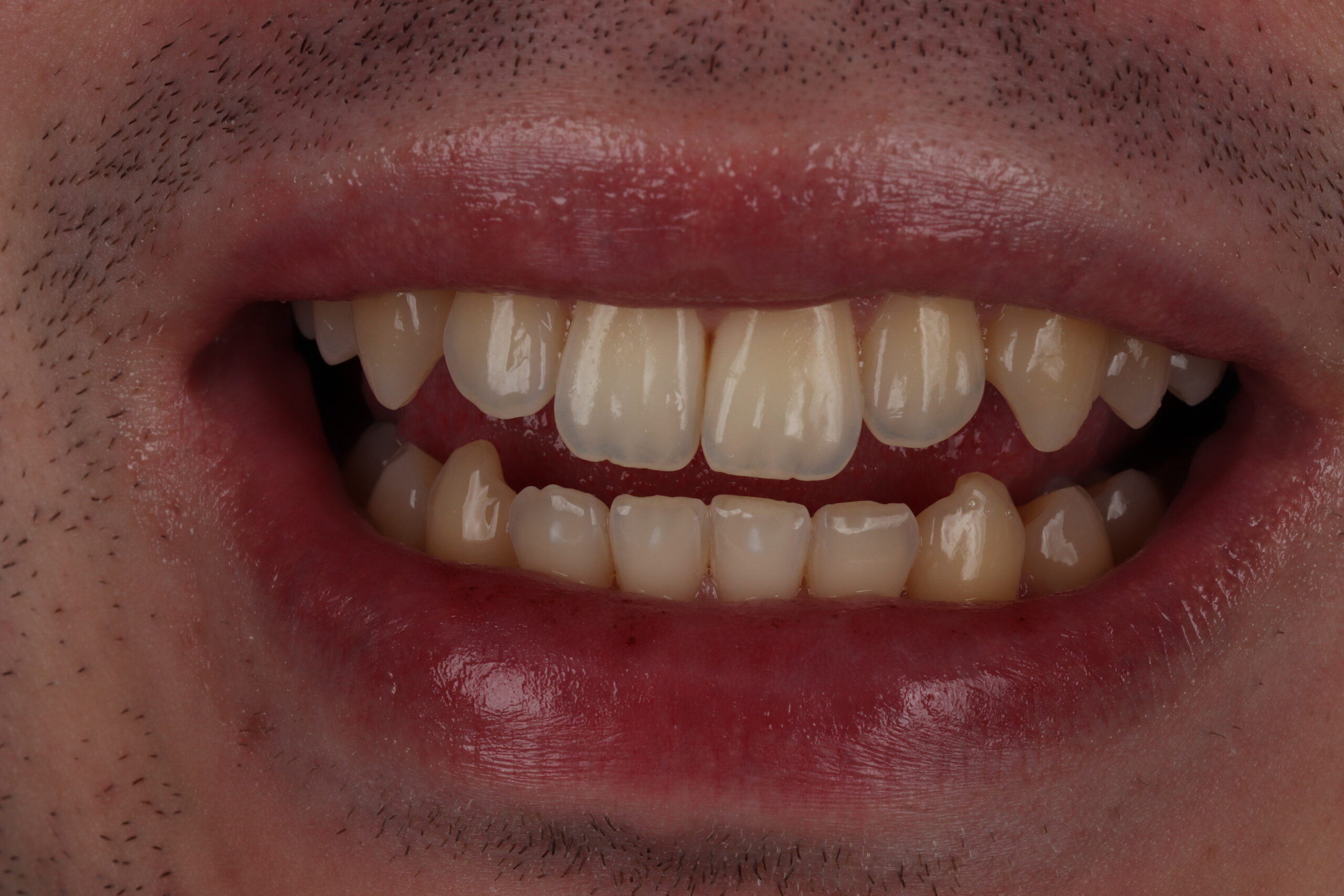 Vorher_Bleaching Vorher_Bleaching